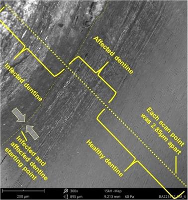 Penetration of SDF and AgF from the infected dentine towards the unaffected tooth structure